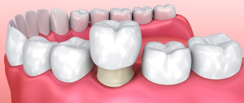Современные зубные коронки: виды, показания и особенности установки
